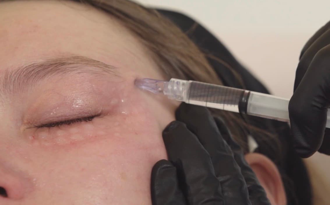 Mesoterapia periocular.